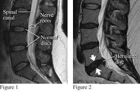 Spinal MRi Chiropractor