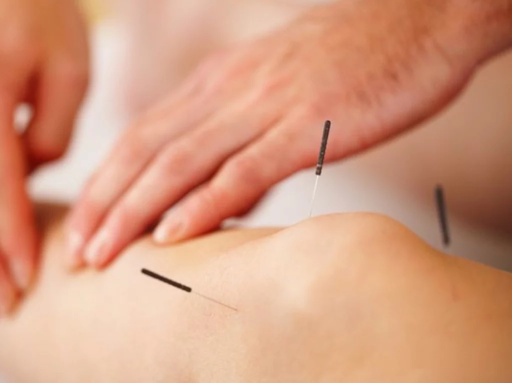 Knee Acupuncture Brisbane