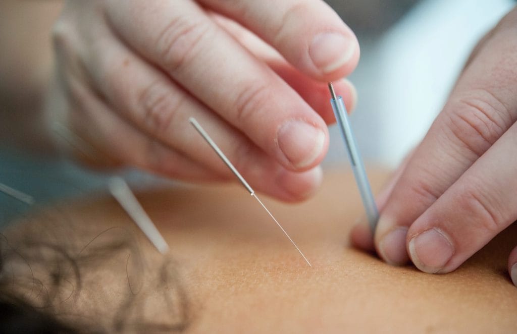 acupuncture brisbane