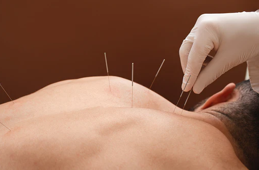 Man Getting Acupuncture Treatment Brisbane