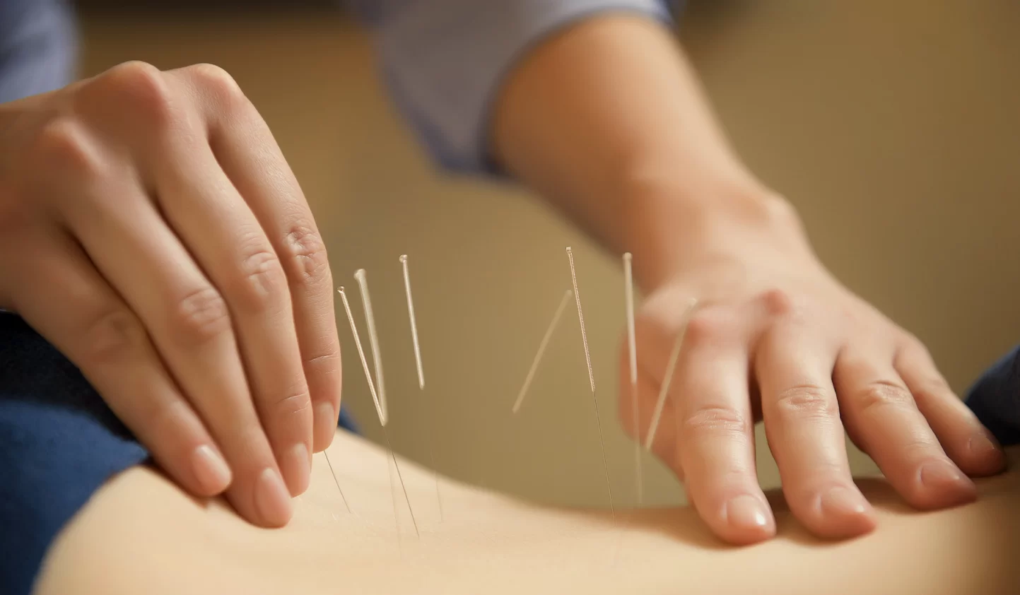 5 Common Conditions Treated by Acupuncture